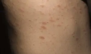 Hud med utslag som kan vara psoriasis i ansiktet. Röda, upphöjda fläckar syns på huden.