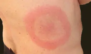 Röd ring på huden, liknande utslag på rumpan och lår. Kan vara ett tecken på borrelia.