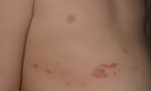 Close-up of a person's torso showing a cluster of small, red, circular rashes on the skin.