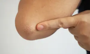 En person pekar på sina torra armbågar med fjällande hud.
