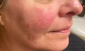 Närbild på en kvinnas kind med synliga röda blodkärl, ett vanligt tecken på rosacea. Fokuserar på hudvård för att hantera tillståndet.