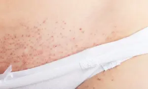Nära bild på irriterad hud efter rakning, med små röda prickar och knottror.