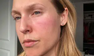 Rodnad och utslag på kinden tyder på en allergisk reaktion i huden i ansiktet.