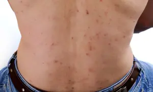 Ryggen visar många röda prickar och en stor pormask.