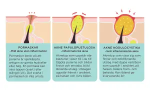 Illustrationer visar olika typer av akne: pormaskar (vita pormaskar), akne papulopustulosa och akne nodulocystika.