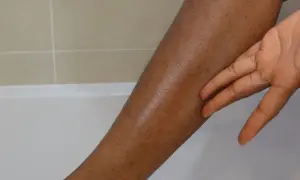 En hand rör vid ett ben med små prickar, liknande jordgubbsben.
