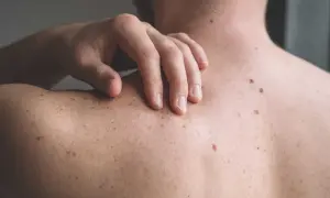 En hand vilar på en rygg täckt av många födelsemärken, som små prickar av svamp på ryggen.