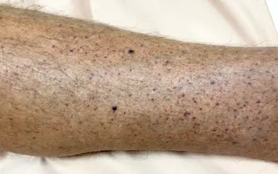 Hud på ett ben med många små lila prickar, tecken på blodbristningar i huden.