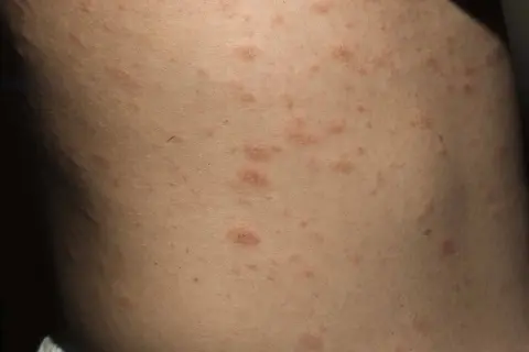 Hud med utslag som kan vara psoriasis i ansiktet. Röda, upphöjda fläckar syns på huden.