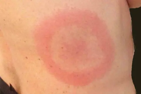 Röd ring på huden, liknande utslag på rumpan och lår. Kan vara ett tecken på borrelia.