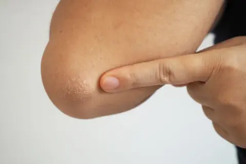 En person pekar på sina torra armbågar med fjällande hud.