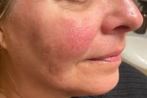 Närbild på en kvinnas kind med synliga röda blodkärl, ett vanligt tecken på rosacea. Fokuserar på hudvård för att hantera tillståndet.