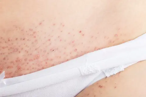 Nära bild på irriterad hud efter rakning, med små röda prickar och knottror.