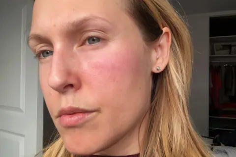 Rodnad och utslag på kinden tyder på en allergisk reaktion i huden i ansiktet.
