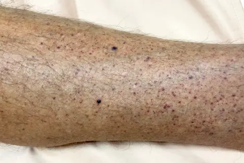 Hud på ett ben med många små lila prickar, tecken på blodbristningar i huden.
