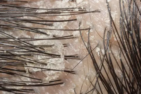 Närbild på hårbotten med synliga fjäll och mörka hårstrån, indikerar torrt hårbotten.