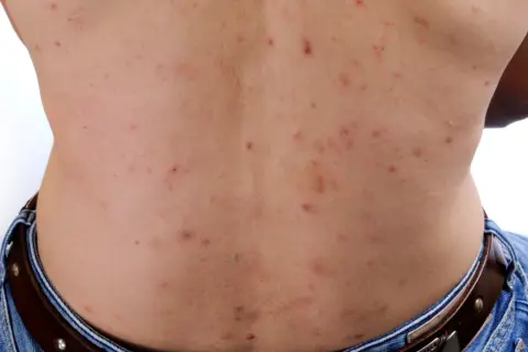 Ryggen visar många röda prickar och en stor pormask.
