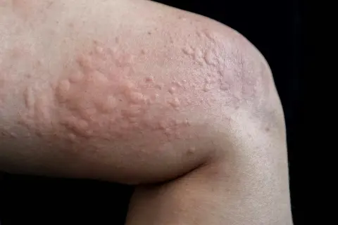 Närbild på hud med upphöjda, röda utslag som liknar nässelutslag. Dessa soleksem bilder visar hur huden kan reagera.