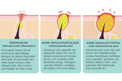 Illustrationer visar olika typer av akne: pormaskar (vita pormaskar), akne papulopustulosa och akne nodulocystika.