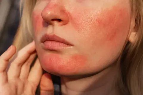Närbild på en persons ansikte med rodnad och synliga porer, typiskt för rosacea utslag.