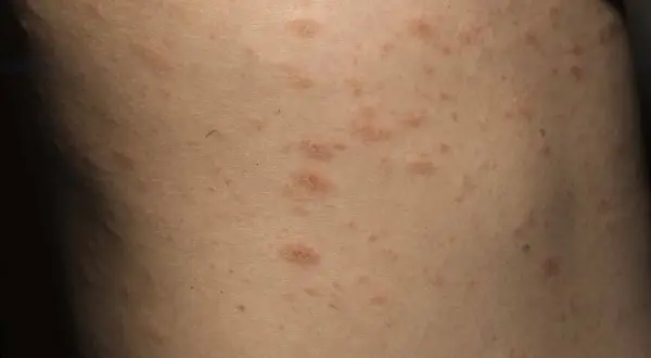 Hud med utslag som kan vara psoriasis i ansiktet. Röda, upphöjda fläckar syns på huden.