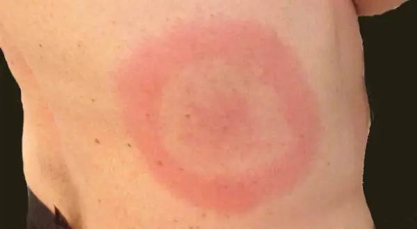 Röd ring på huden, liknande utslag på rumpan och lår. Kan vara ett tecken på borrelia.