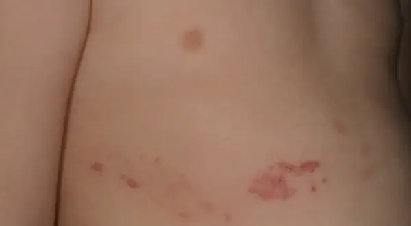Close-up of a person's torso showing a cluster of small, red, circular rashes on the skin.