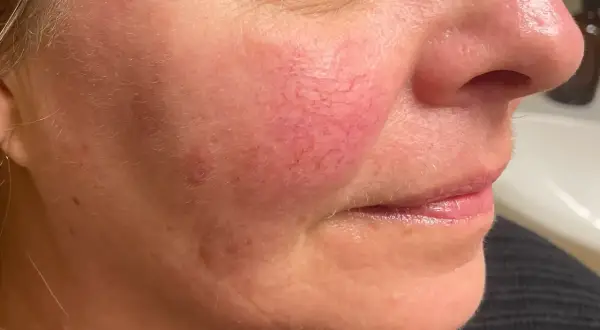 Närbild på en kvinnas kind med synliga röda blodkärl, ett vanligt tecken på rosacea. Fokuserar på hudvård för att hantera tillståndet.