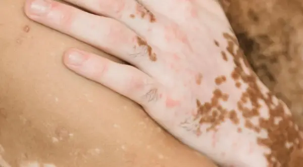 Närbild på en hand med vitiligo som vilar på hud med liknande pigmentförändringar, som kan liknas vid finnar på låren.