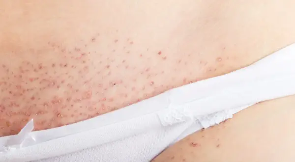Nära bild på irriterad hud efter rakning, med små röda prickar och knottror.