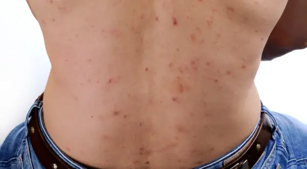 Ryggen visar många röda prickar och en stor pormask.