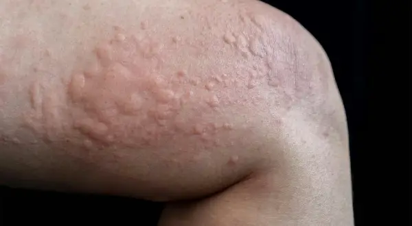 Närbild på hud med upphöjda, röda utslag som liknar nässelutslag. Dessa soleksem bilder visar hur huden kan reagera.