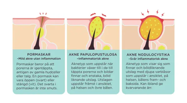 Illustrationer visar olika typer av akne: pormaskar (vita pormaskar), akne papulopustulosa och akne nodulocystika.