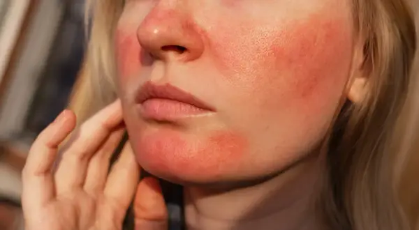 Närbild på en persons ansikte med rodnad och synliga porer, typiskt för rosacea utslag.