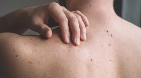 En hand vilar på en rygg täckt av många födelsemärken, som små prickar av svamp på ryggen.