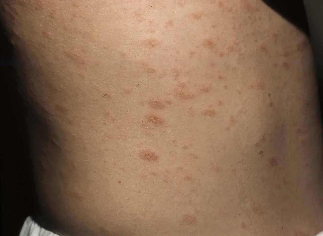 Hud med utslag som kan vara psoriasis i ansiktet. Röda, upphöjda fläckar syns på huden.