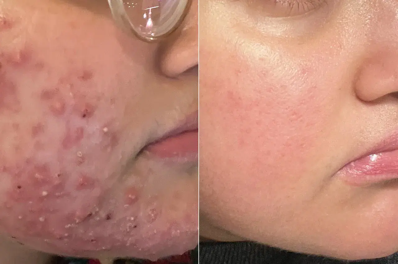 Före- och efterbilder visar en hud med svamp utslag som blivit ren och slät.