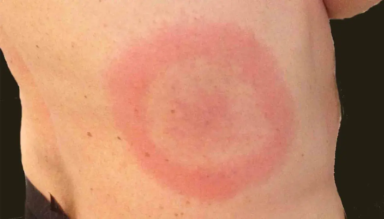 Röd ring på huden, liknande utslag på rumpan och lår. Kan vara ett tecken på borrelia.