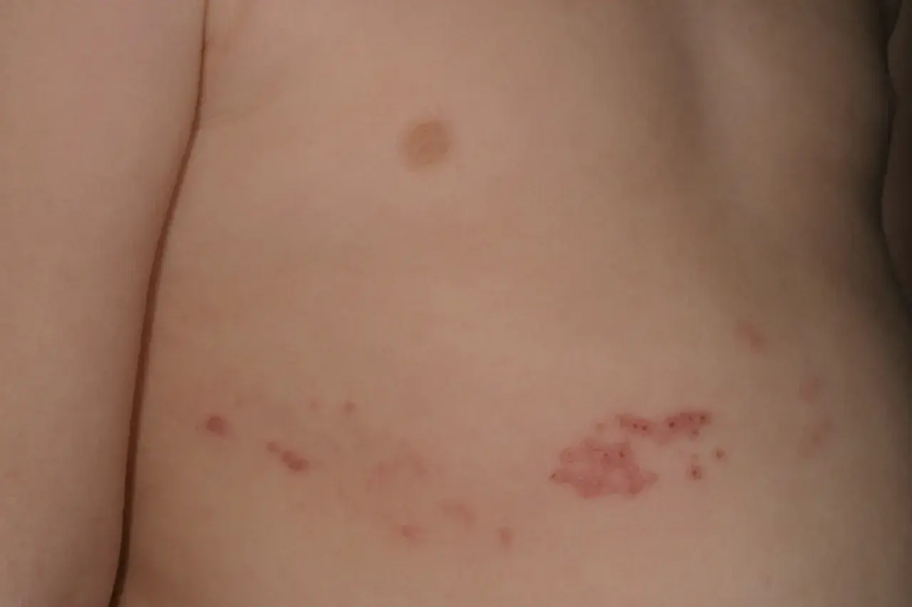 Close-up of a person's torso showing a cluster of small, red, circular rashes on the skin.