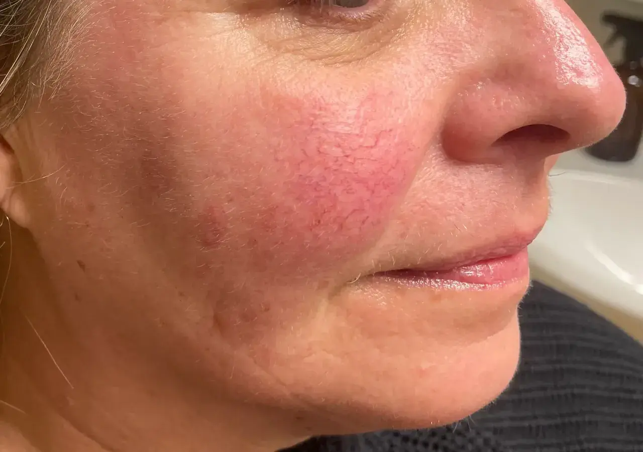 Närbild på en kvinnas kind med synliga röda blodkärl, ett vanligt tecken på rosacea. Fokuserar på hudvård för att hantera tillståndet.