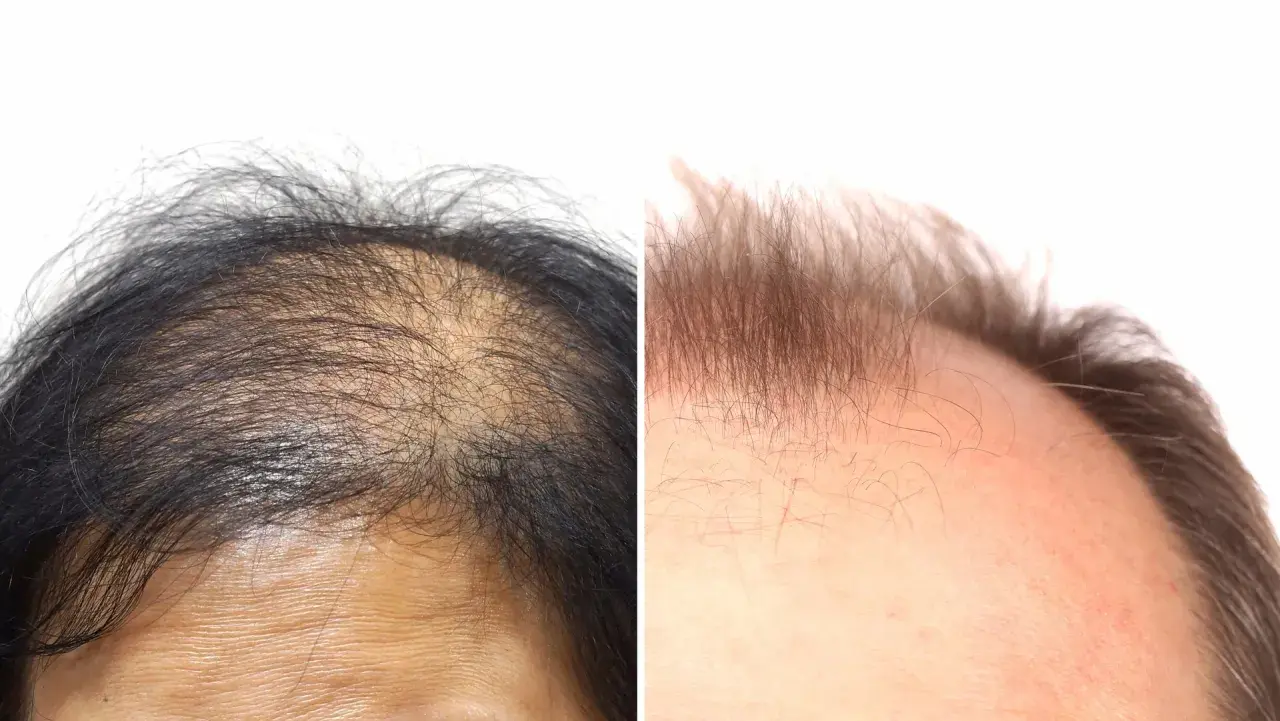 Före- och efterbilder visar skillnaden på hårväxt. Till vänster syns en person som tappar mycket hår, till höger en fylligare frisyr.