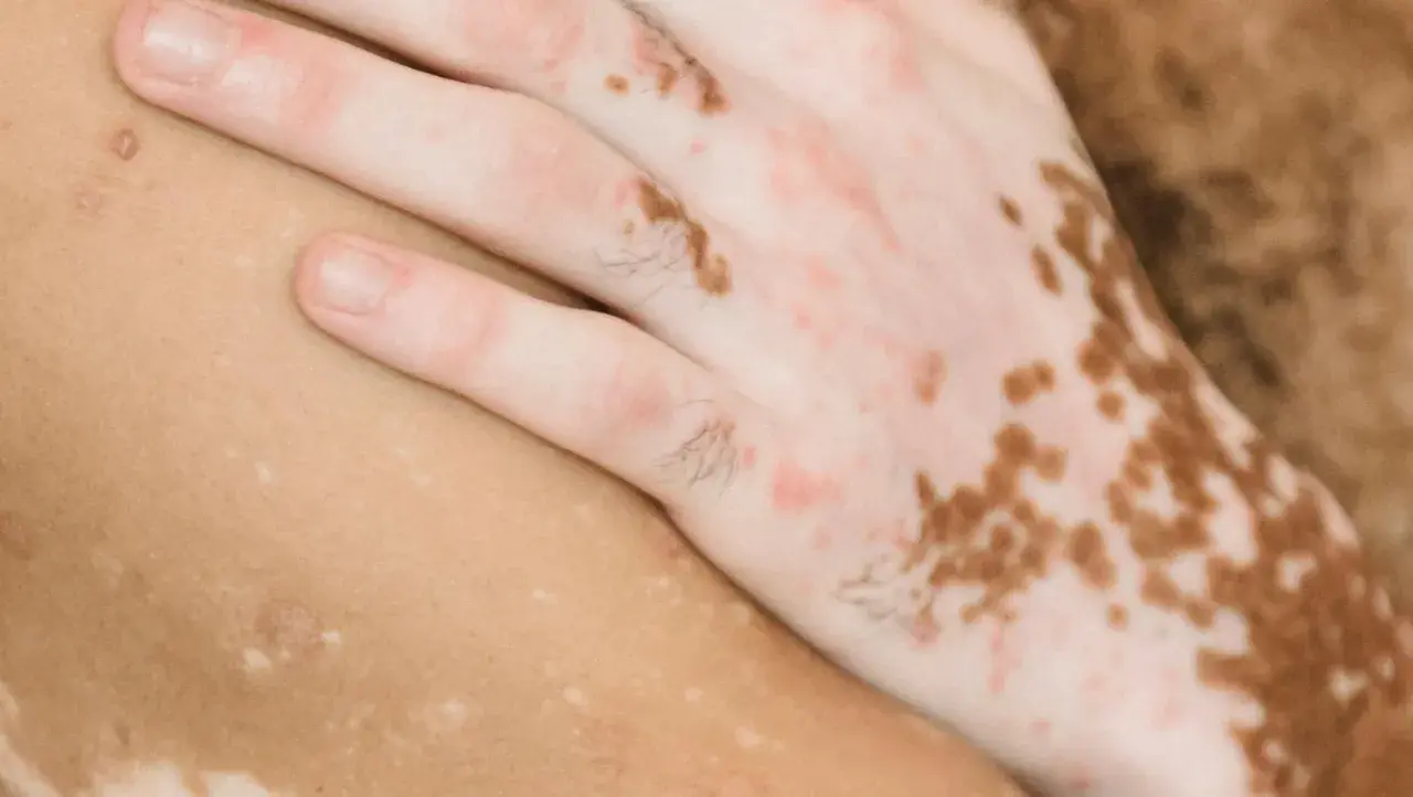 Närbild på en hand med vitiligo som vilar på hud med liknande pigmentförändringar, som kan liknas vid finnar på låren.