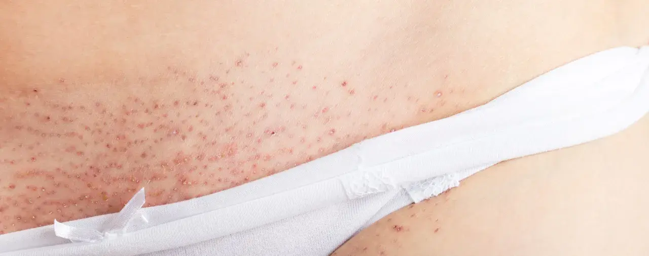 Nära bild på irriterad hud efter rakning, med små röda prickar och knottror.