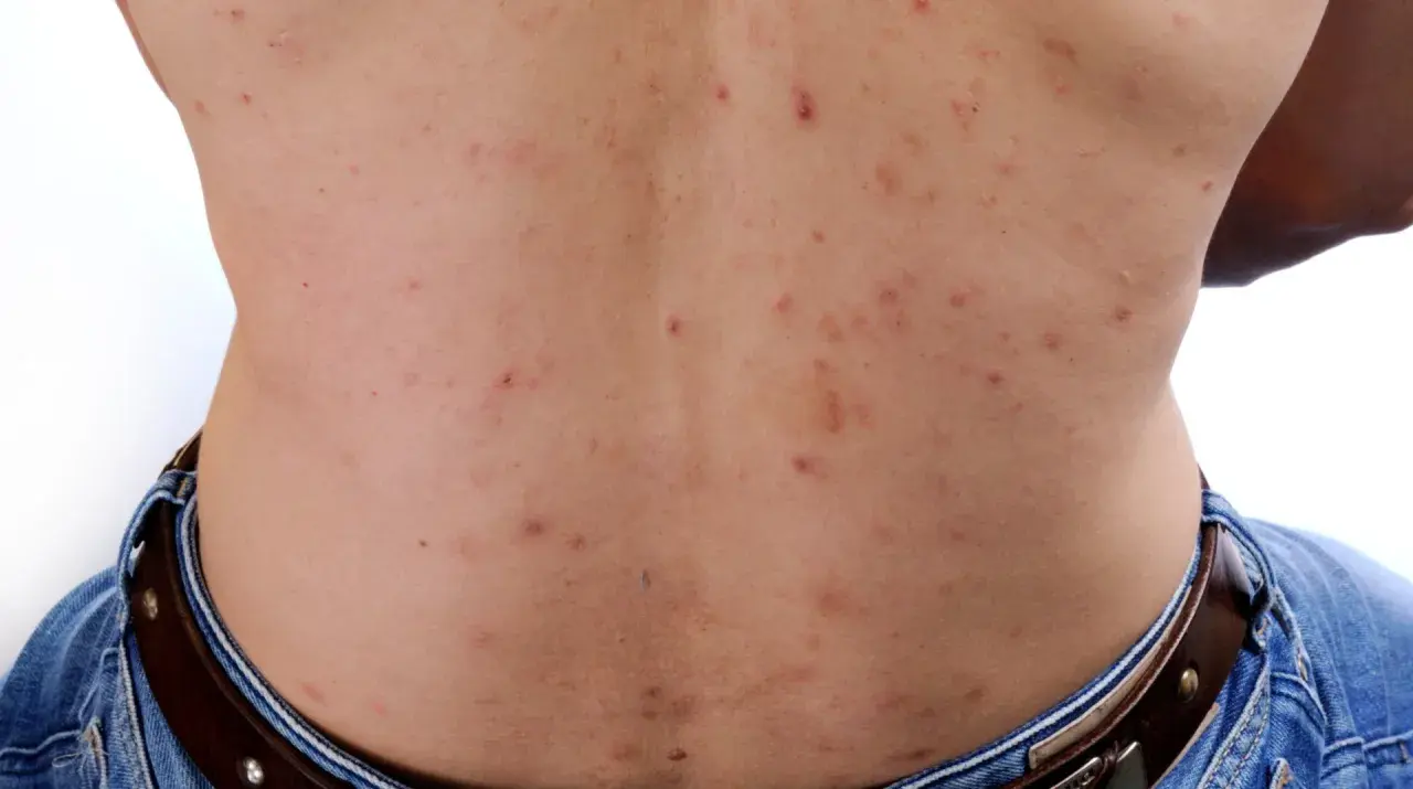 Ryggen visar många röda prickar och en stor pormask.
