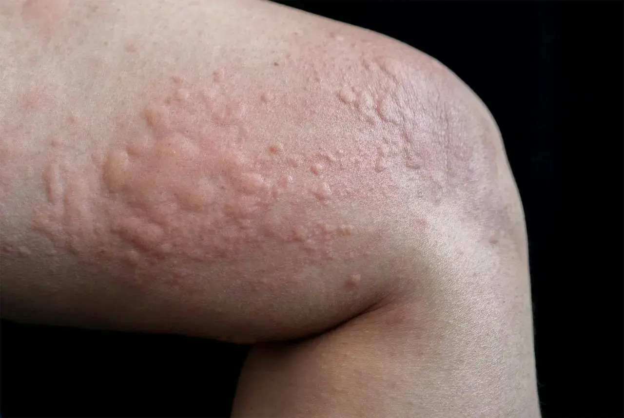Närbild på hud med upphöjda, röda utslag som liknar nässelutslag. Dessa soleksem bilder visar hur huden kan reagera.