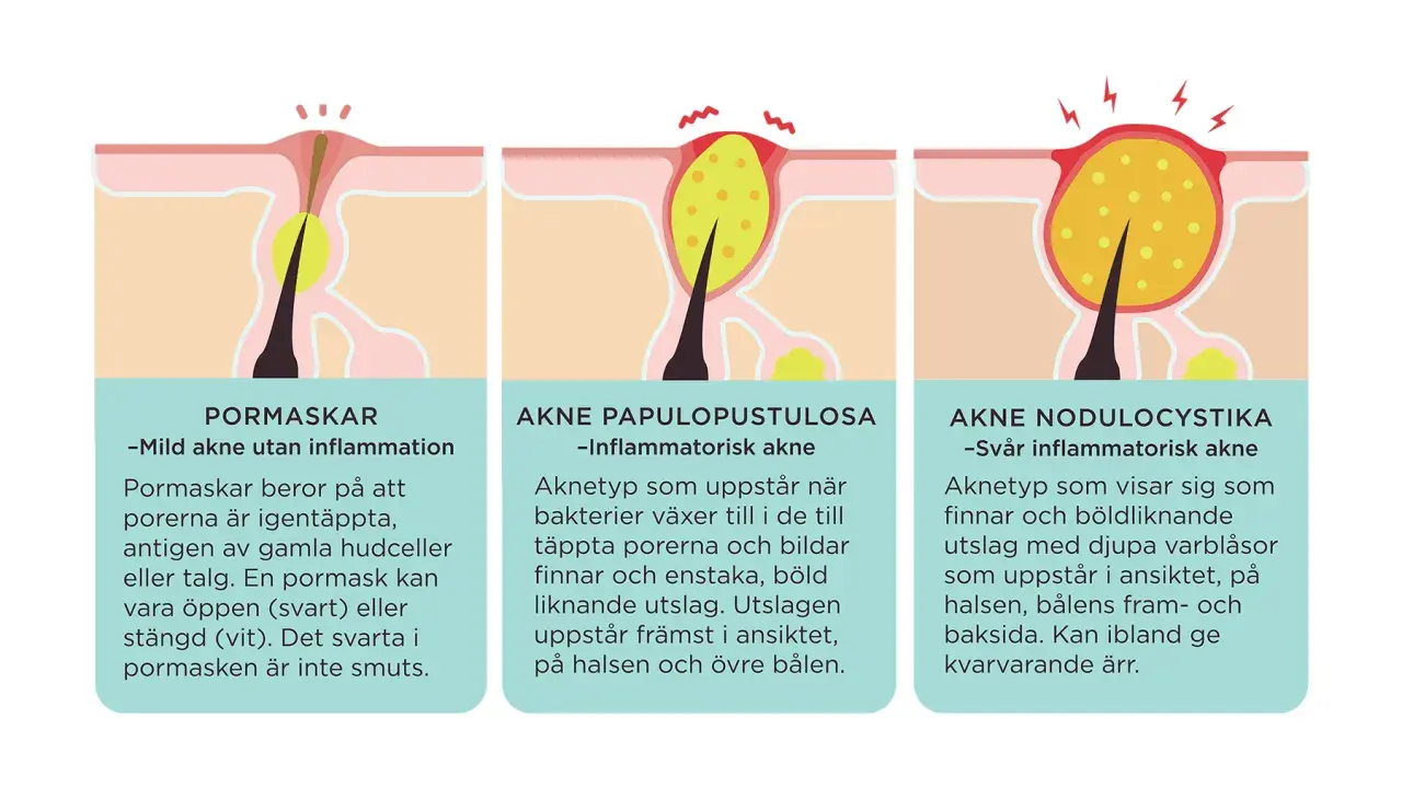 Illustrationer visar olika typer av akne: pormaskar (vita pormaskar), akne papulopustulosa och akne nodulocystika.