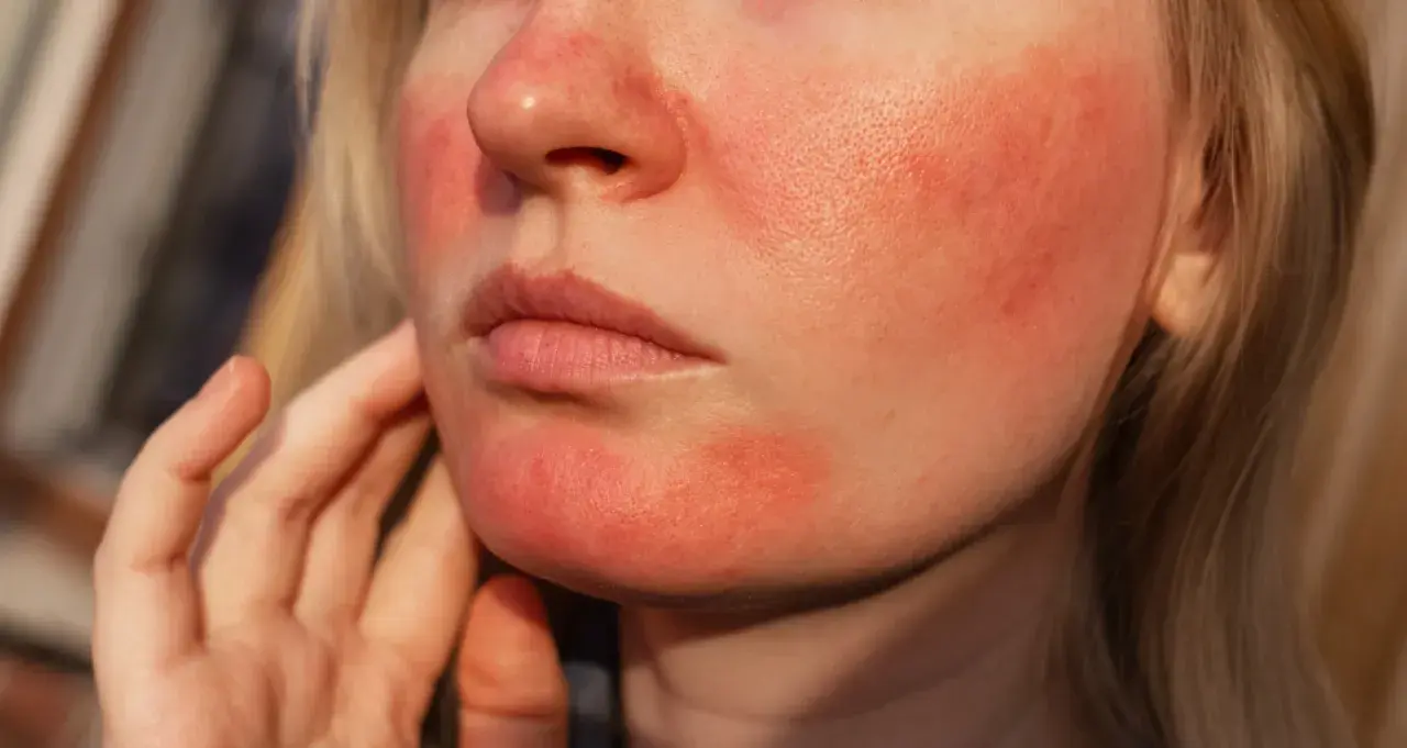 Närbild på en persons ansikte med rodnad och synliga porer, typiskt för rosacea utslag.