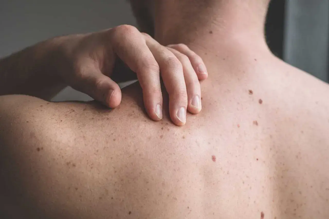 En hand vilar på en rygg täckt av många födelsemärken, som små prickar av svamp på ryggen.