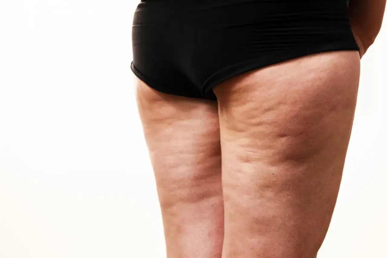 En närbild på en persons lår och rumpa som visar celluliter. Drömmer du om att få bort celluliter på 2 veckor?