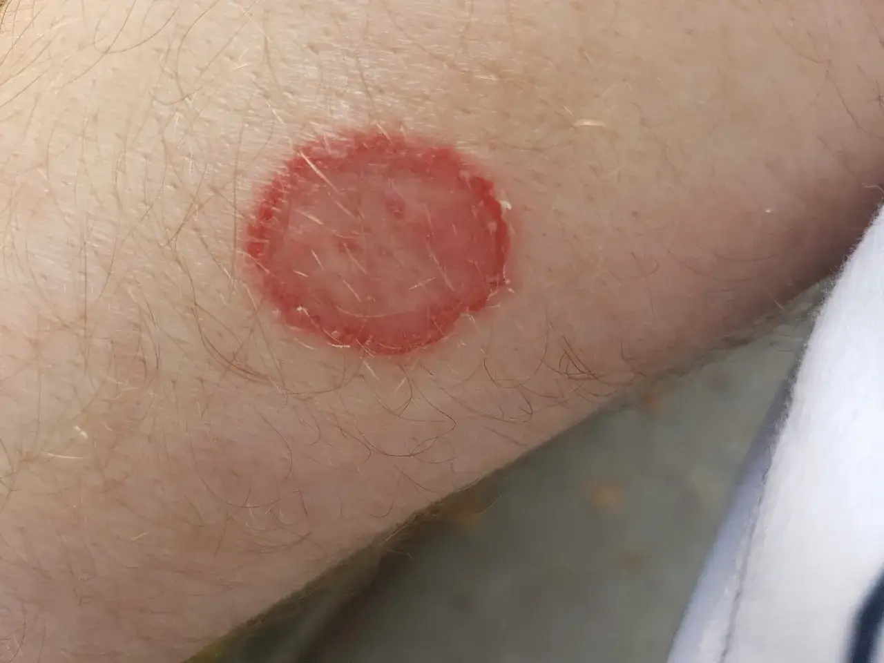 R&ouml;d, ringformad hudirritation p&aring; en arm, som en svamp p&aring; rumpan.